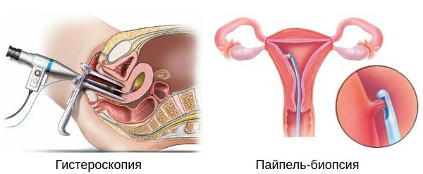Гистероскопия и трубочная биопсия