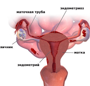 Эндометриоз