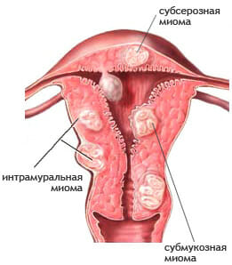 Миома матки