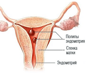 Полипы в матке