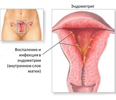 Эндометрит