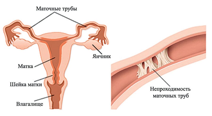 Спайки в маточных трубах